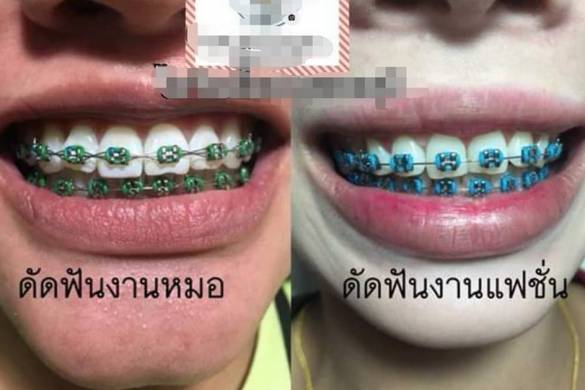 La mode dangereuse des faux appareils dentaires en Thaïlande