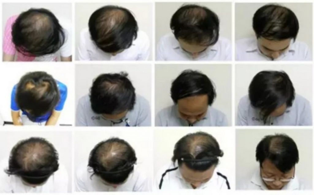 La Thaïlande découvre un moyen de traiter la perte de cheveux