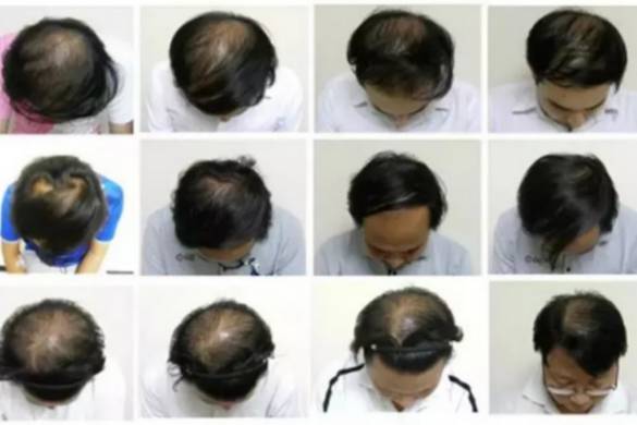 La Thaïlande découvre un moyen de traiter la perte de cheveux