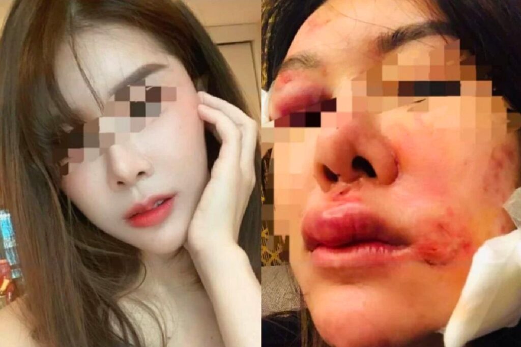 Une Thaïlandaise sauvagement mordue par son petit ami proche d'un policier