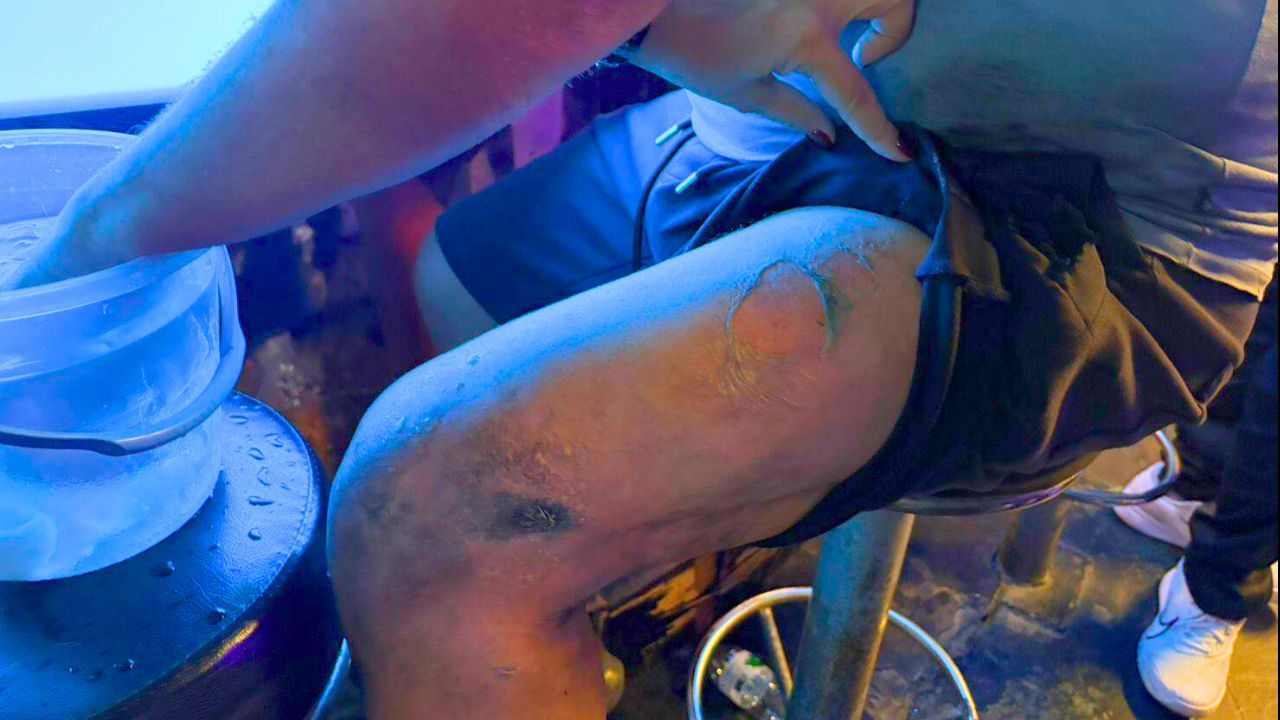 La jambe gauche du touriste belge a été brûlée après l'explosion de sa batterie.