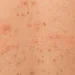 Éruption cutanée avec multiples lésions sur le dos pouvant évoquer une infection dermatologique