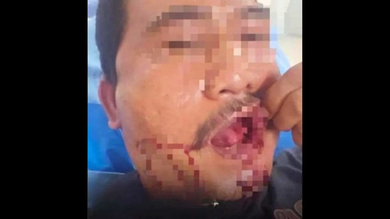 Chauffeur de tuk-tuk blessé à la bouche après avoir été agressé par un Britannique à Patong, sur l'île de Phuket